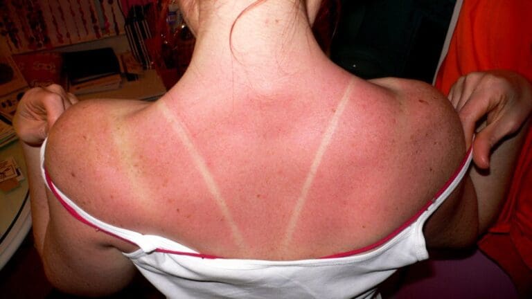 Neuer absurder Trend: Sonnenbrand aufschminken — Sunburn / wikimedia (CC BY-SA 2.0)